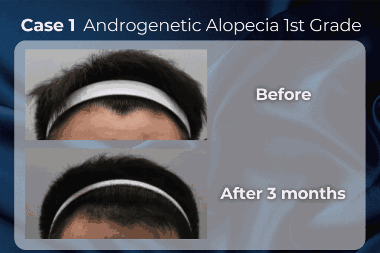Exohair cases result 1