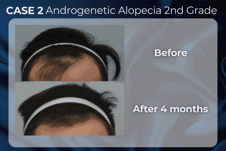 Exohair cases result 2