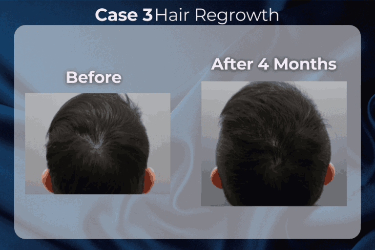 Exohair cases result 3