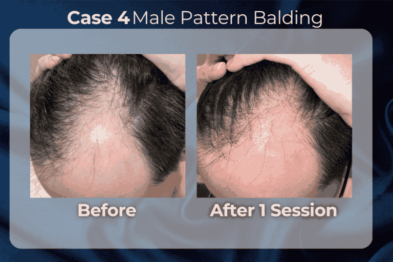 Exohair cases result 4
